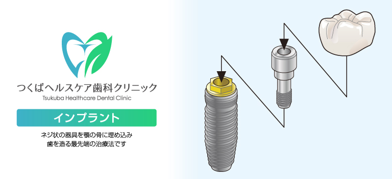 つくばヘルスケア歯科クリニック・インプラント