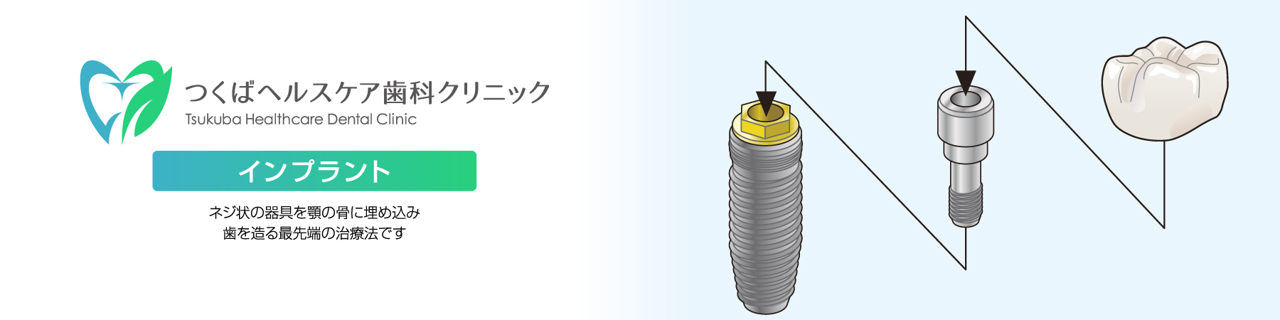 つくばヘルスケア歯科クリニック・インプラント