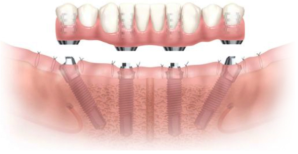 ノーベル・バイオケア・オールオン 4は 4本のインプラントで総入歯を固定できます
