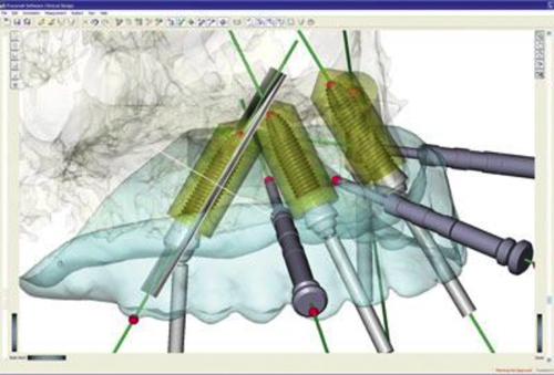 ノーベル・クリニシャン・CT上のデータを元に作製されたサージカルガイド（ノーベルガイド）を用いた手術のサポートをする重要なソフトです